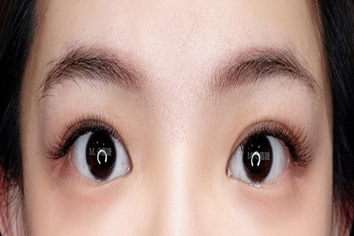 Mego 美睫 臉部撥筋