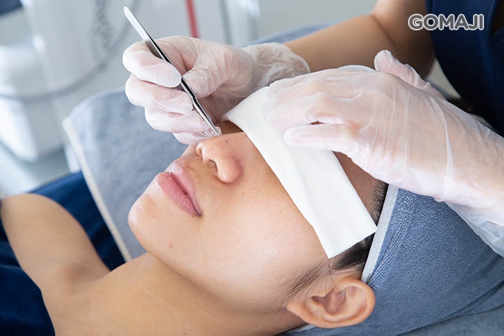 黑頭粉刺手工清潔