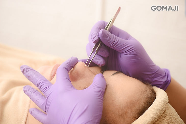 專業無痛粉刺清除