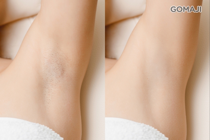 玫瑰植萃腋下熱蠟除毛