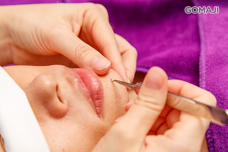 手工清粉刺痘痘 