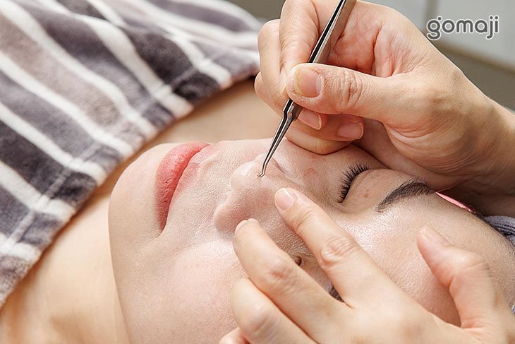 粉刺痘痘清潔調理