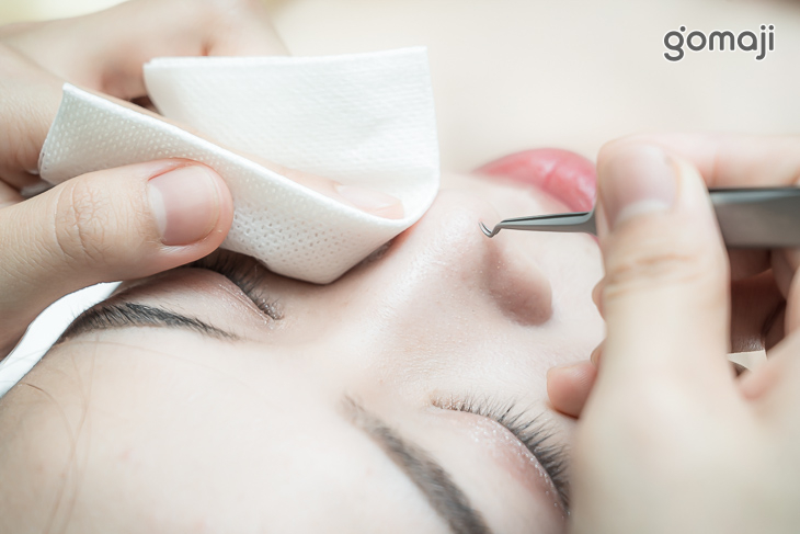 全臉粉刺面皰淨化