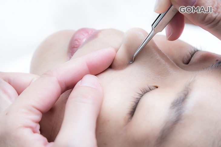 全臉痘痘粉刺淨化