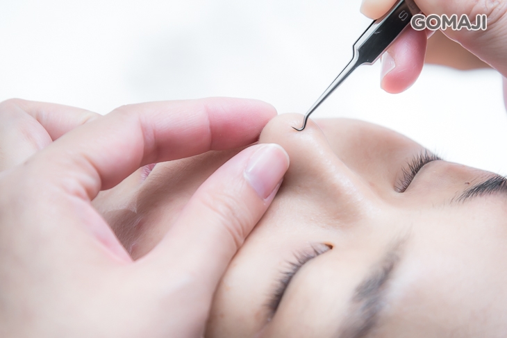 全臉痘痘粉刺淨化