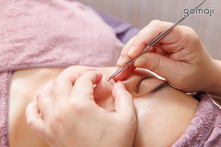 全臉黑頭粉刺痘痘淨化清除