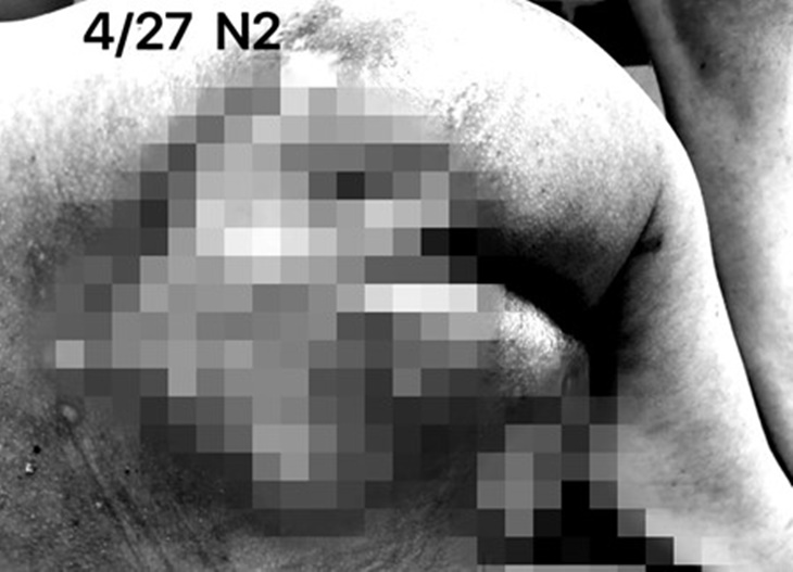 北部慢性傷口患者照護計畫