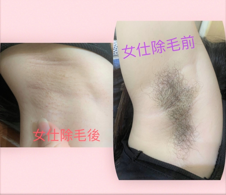 自信舉手腋下熱蠟除毛