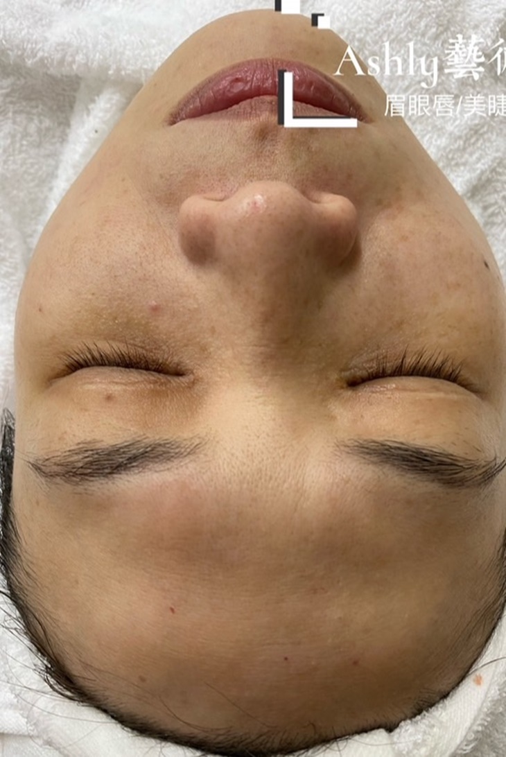 液態皮秒臉部SPA