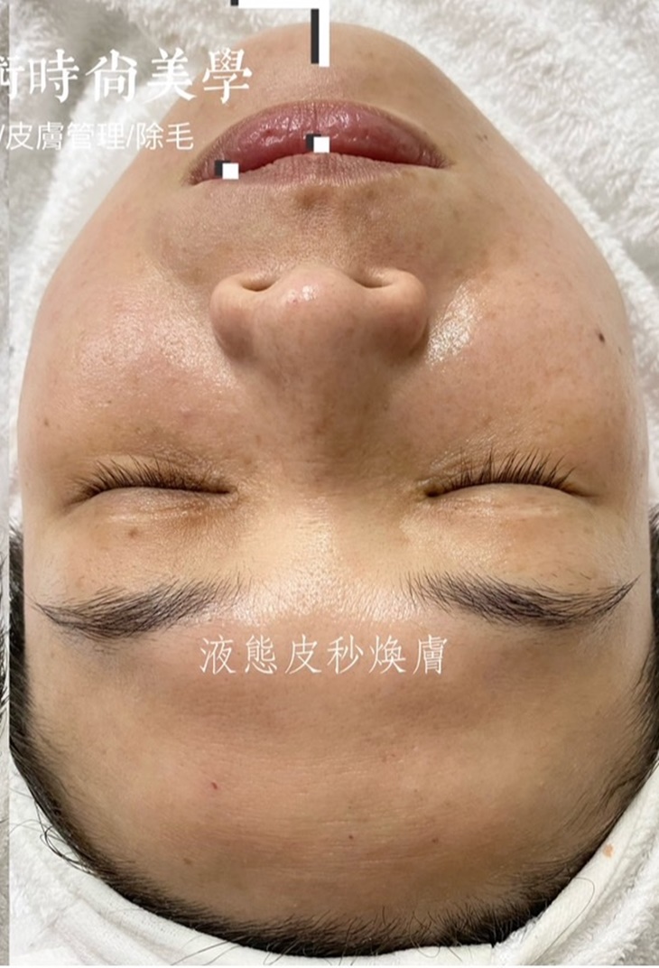 液態皮秒臉部SPA