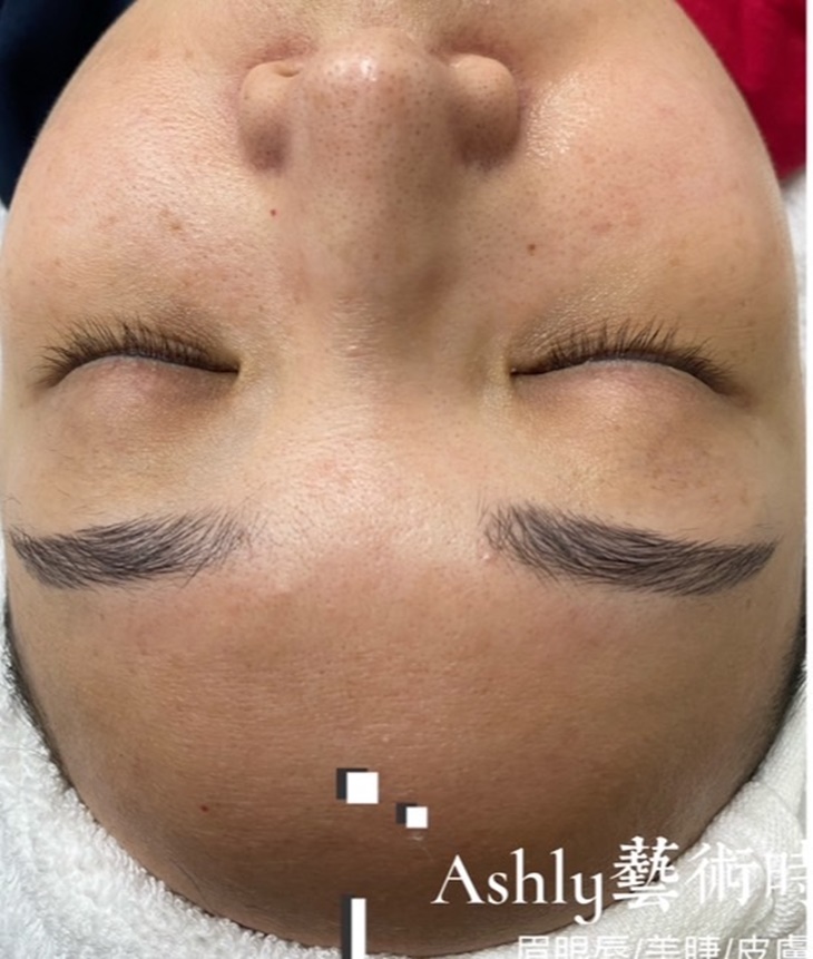 液態皮秒臉部SPA