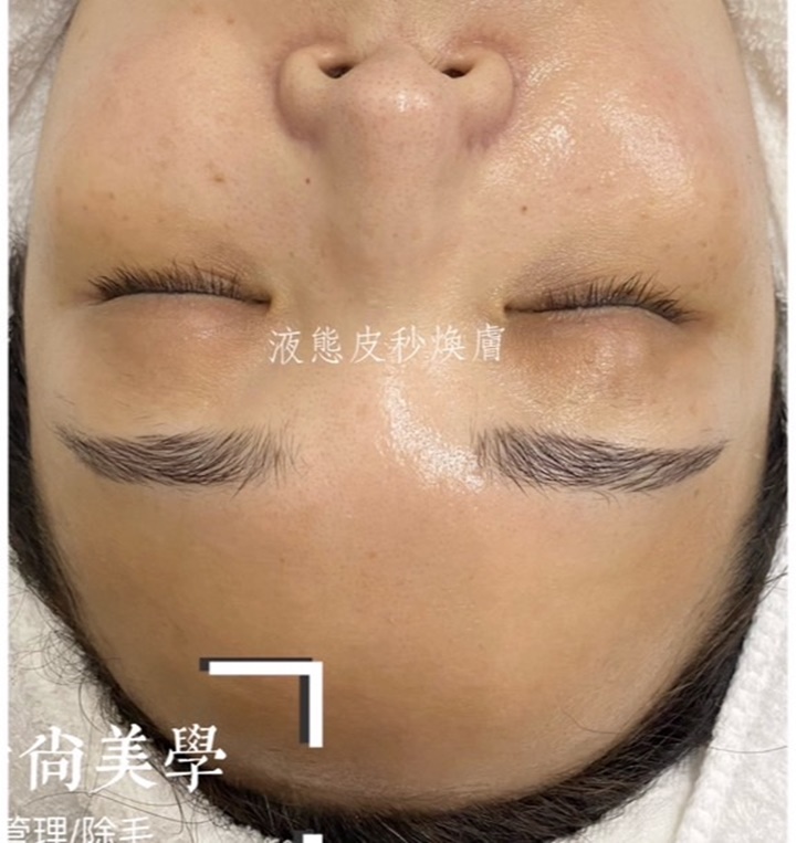 液態皮秒臉部SPA