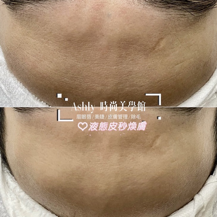 液態皮秒臉部SPA