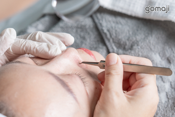 粉刺痘痘手工淨化調理