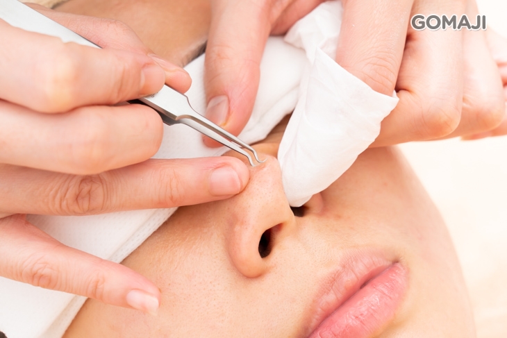 專業手工重點加強粉刺淨化 