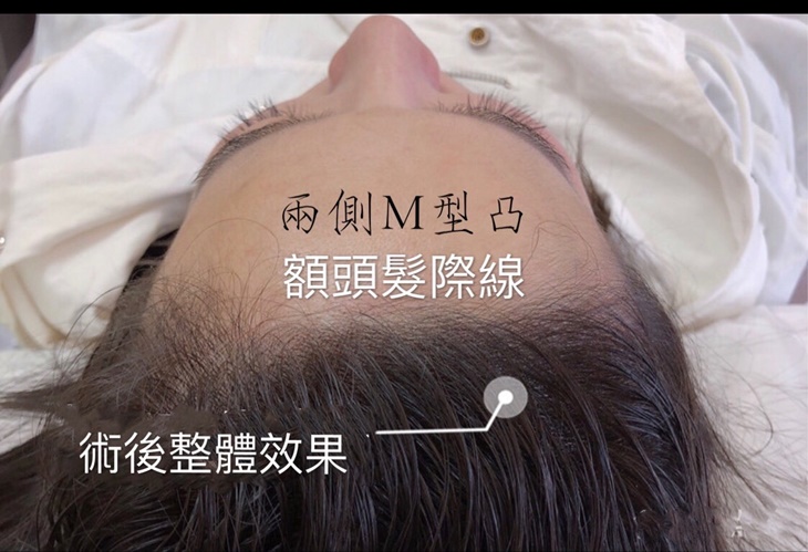 增髮髮際線