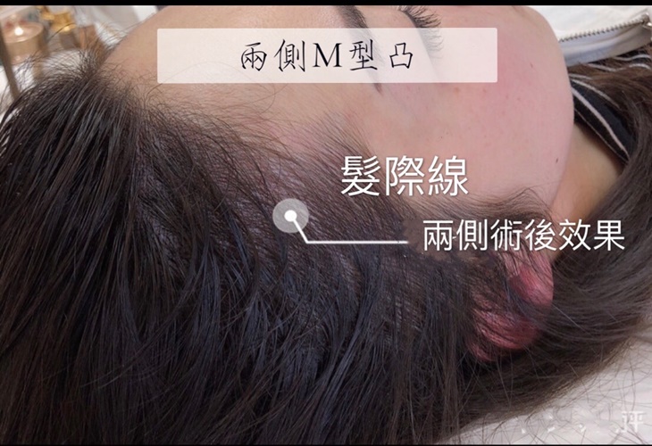 增髮髮際線