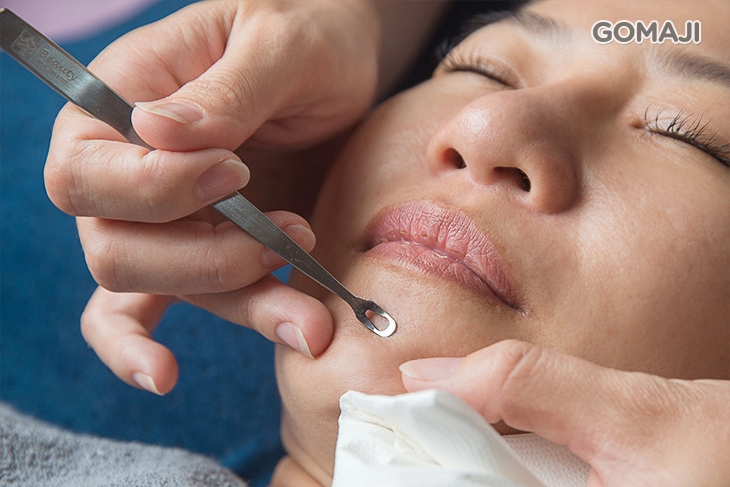 手工黑頭粉刺痘痘淨化毛孔