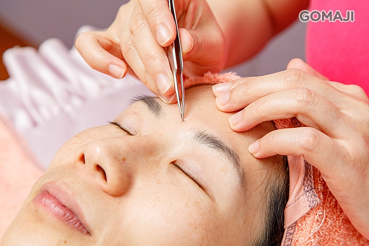 專業手工技術粉刺痘痘調理