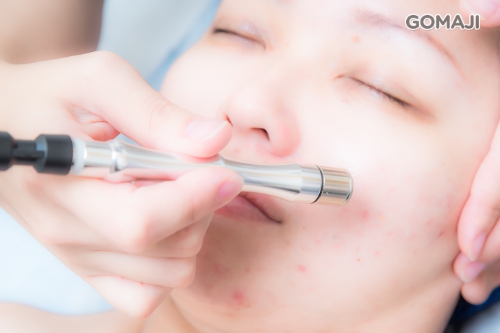  鑽石微雕角質更新