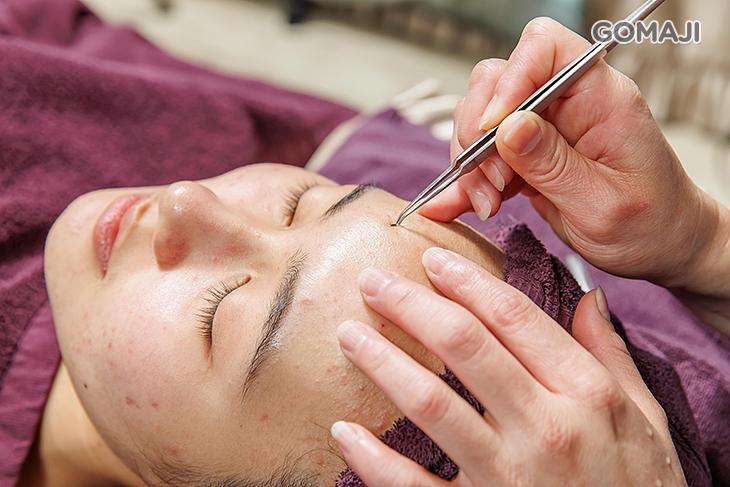 手工淨痘清潔黑頭粉刺