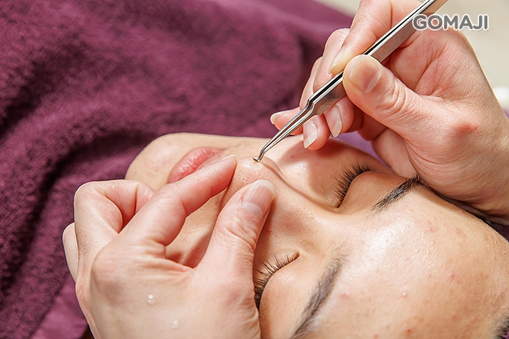 手工淨痘清潔黑頭粉刺