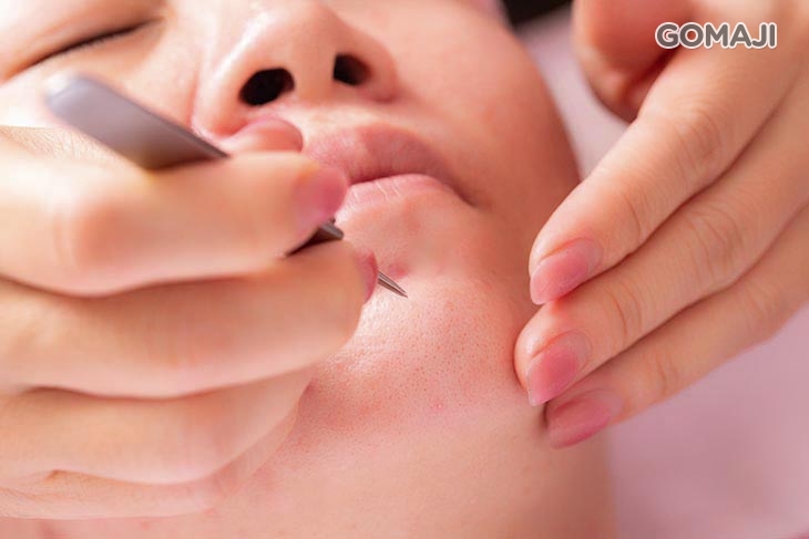 專業手工清除痘痘粉刺