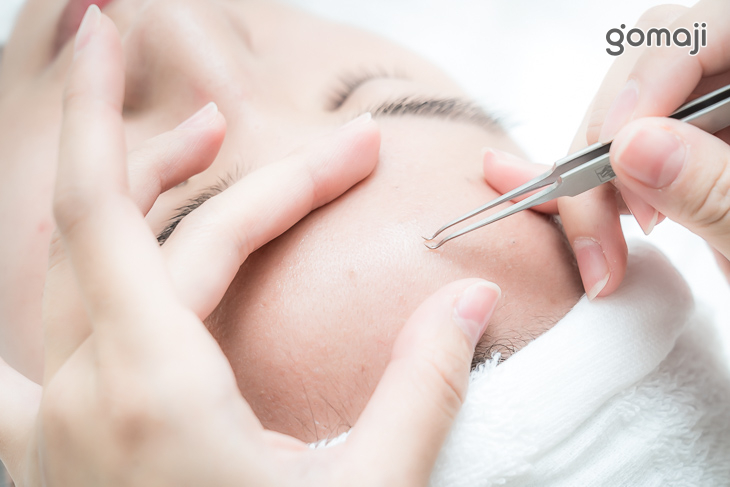 粉刺清除及痘痘處理