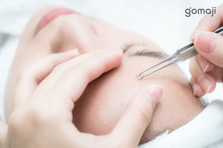 粉刺清除及痘痘處理