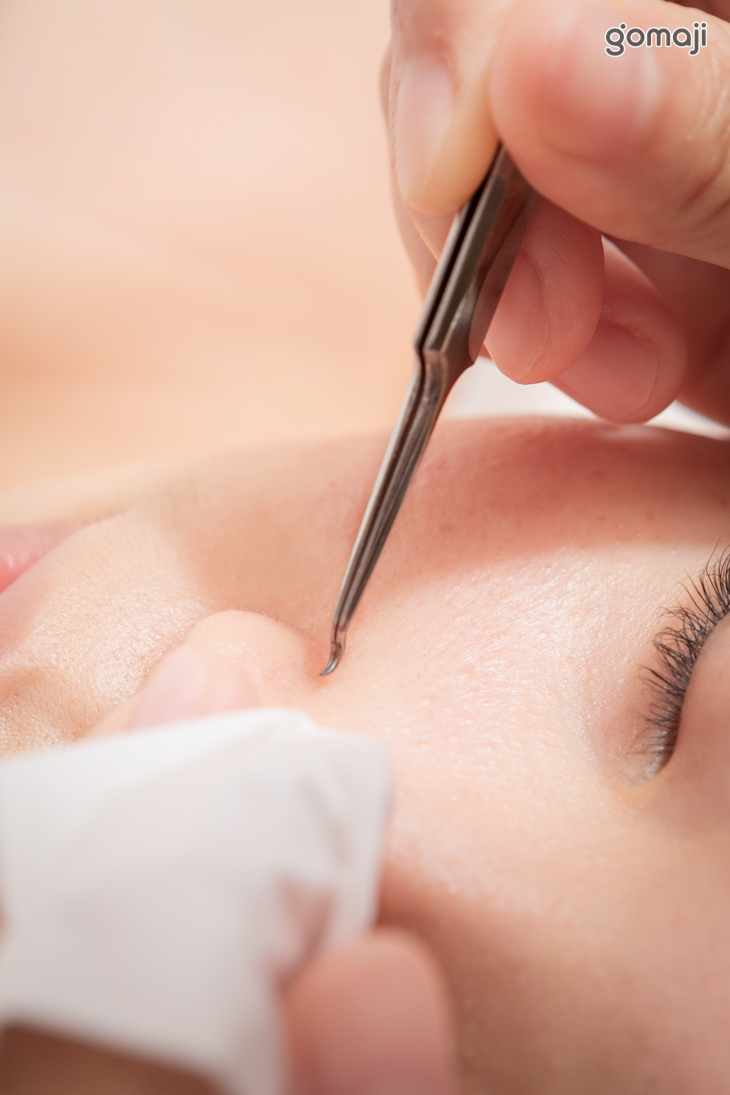 精油手工粉刺調理