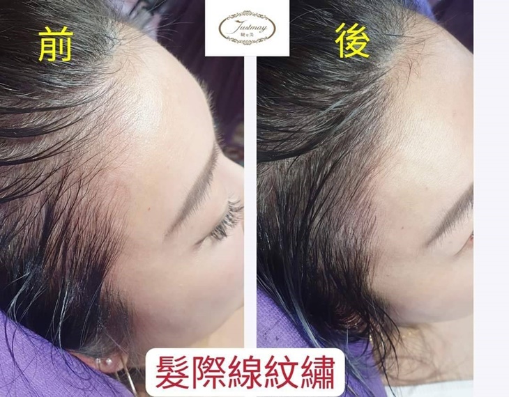 專業量身訂製-30年國家美容乙級專業資歷！仿真髮際線(分線明顯、落髮、高額救星)