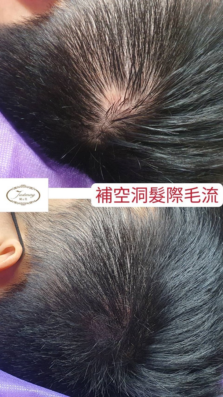 專業量身訂製-30年國家美容乙級專業資歷！仿真髮際線(分線明顯、落髮、高額救星)