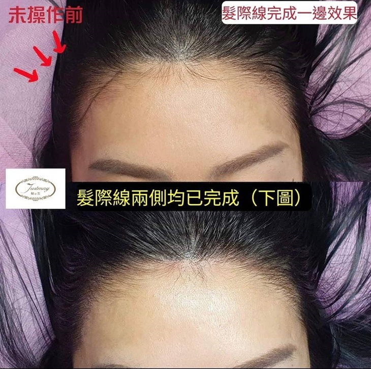 專業量身訂製-30年國家美容乙級專業資歷！仿真髮際線(分線明顯、落髮、高額救星)