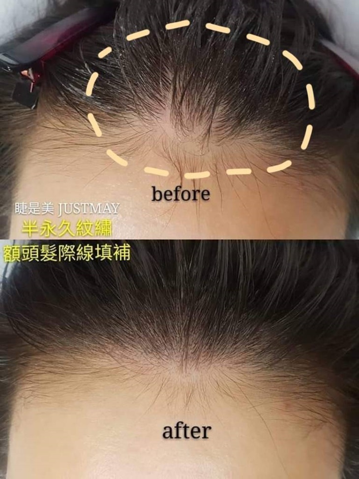 專業量身訂製-30年國家美容乙級專業資歷！仿真髮際線(分線明顯、落髮、高額救星)