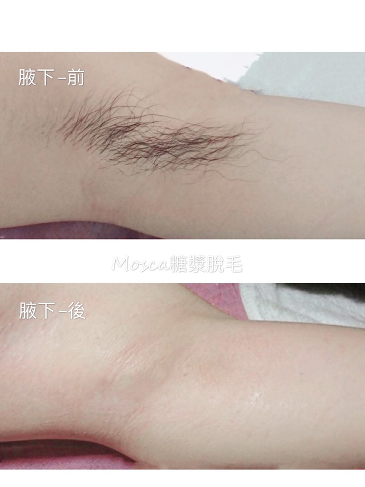 匈牙利PANDHY'S天然糖漿溫和腋下除毛保養課程