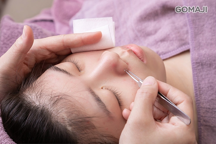 全臉痘痘粉刺淨化清除