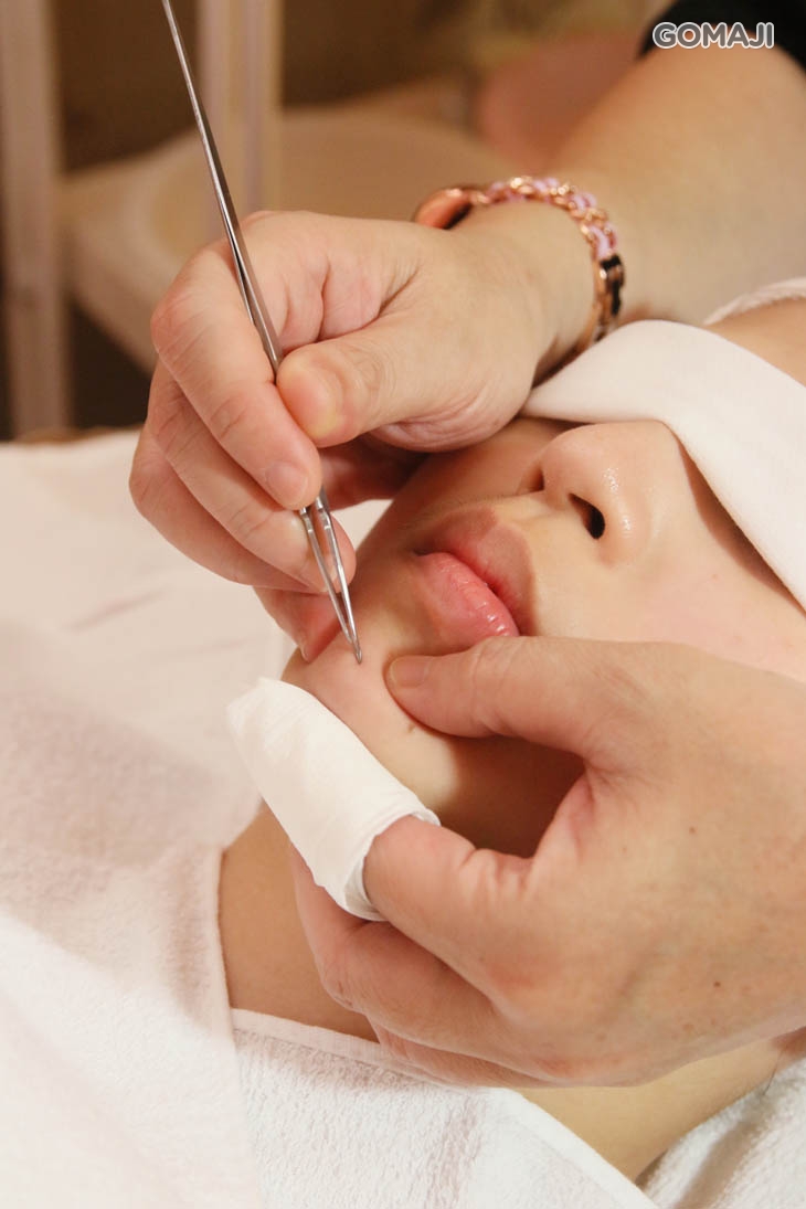 重點手工粉刺痘痘清潔