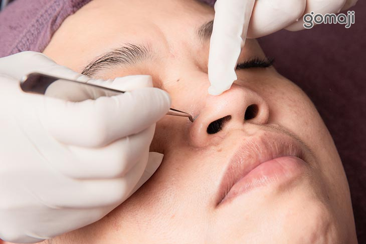 粉刺痘痘淨化調理