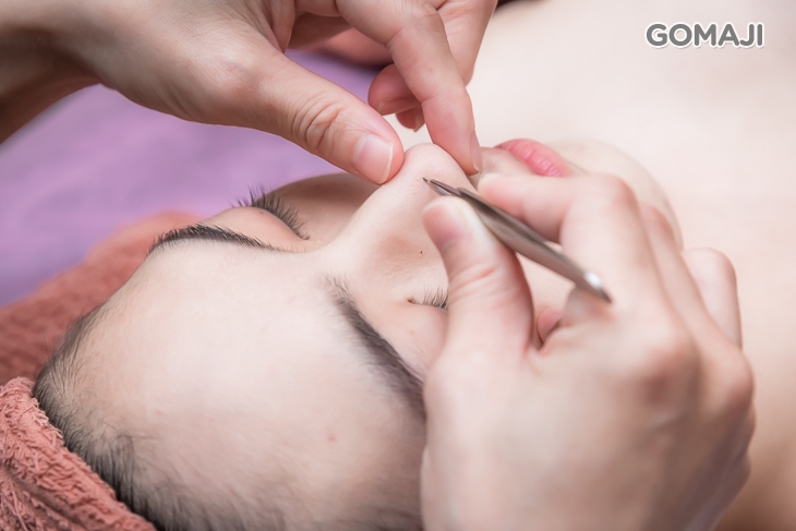  專業粉刺淨化清除