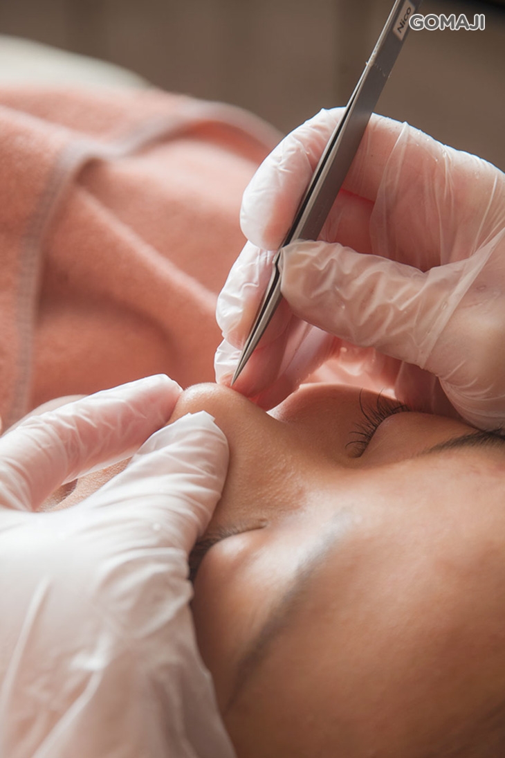 手工清粉刺痘痘