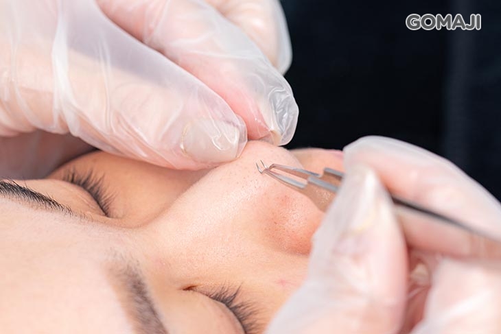 專業手工粉刺調理