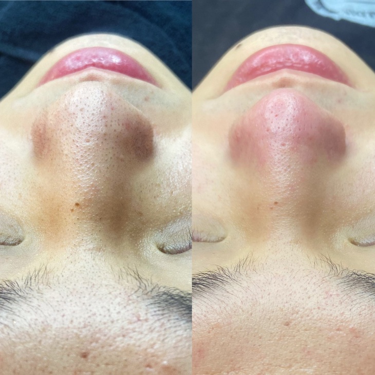 超有感肌膚呵護-溫和深層粉刺清潔