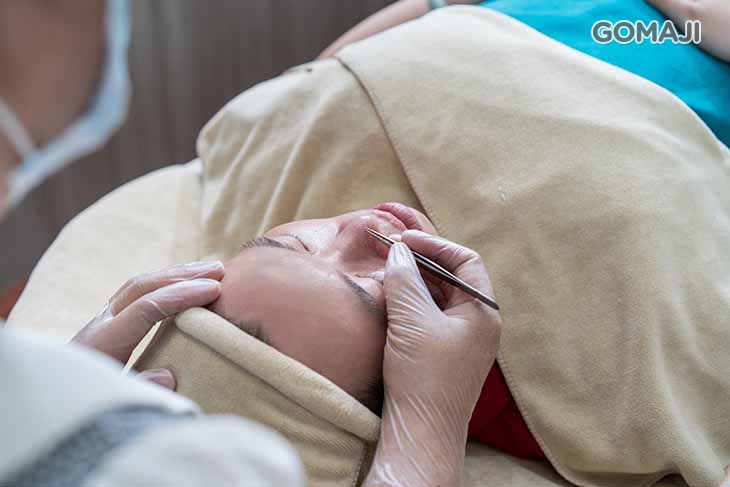 專業手工淨痘粉刺(粉刺、內皰、閉鎖性粉刺)