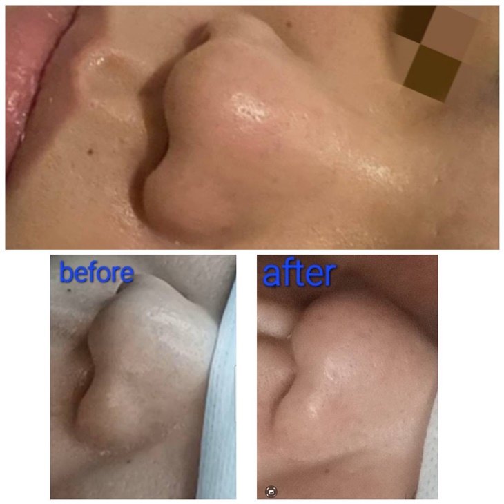 手工無痕清粉刺