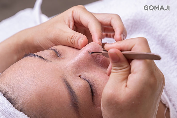 專業手工深層粉刺淨化(含閉鎖性粉刺、內包性痘痘)