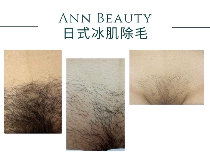 日式冰肌VIO全除