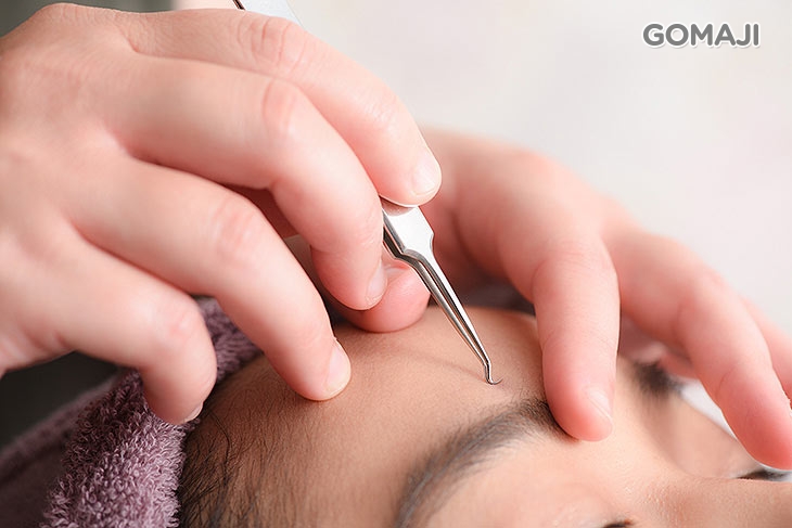 全臉專業粉刺痘痘清除