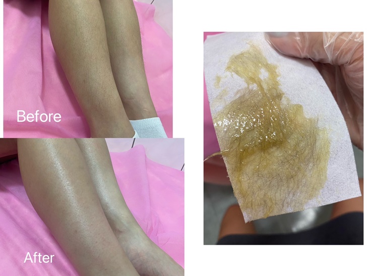 小腿除毛