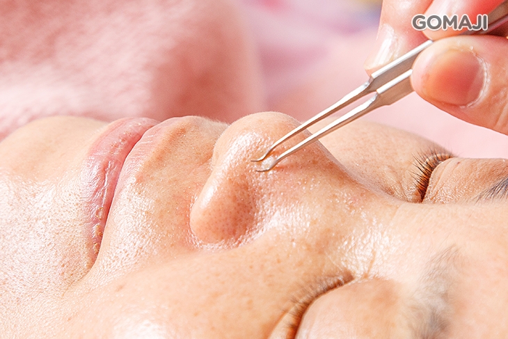 全臉純手技除痘粉刺淨化