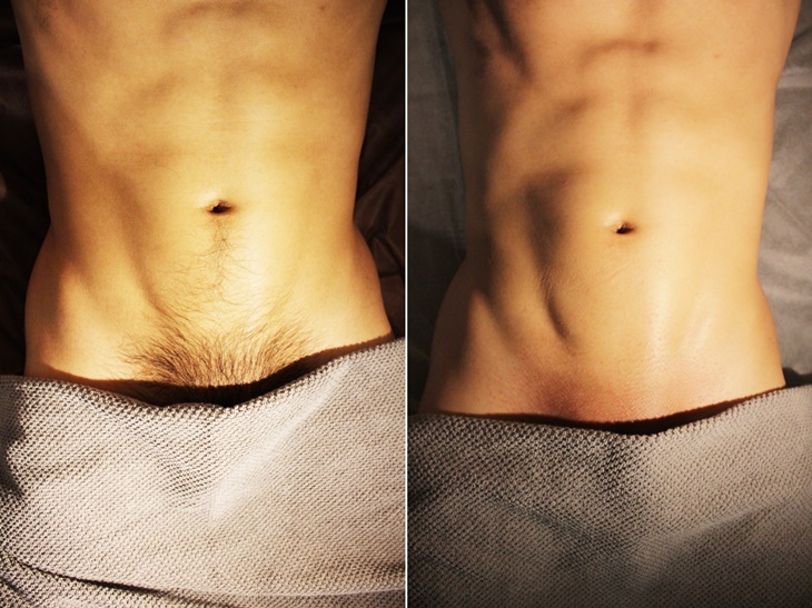 男性私密處舒適計畫(V+B)